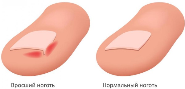 Протезирование ногтей на ногах, руках гелем Gehwol, полигелем, акрилом. Фото, цены, отзывы