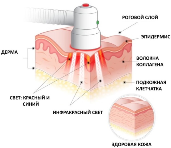 PUVA therapy (ПУВА-терапия). Что это такое от псориаза, алопеции, витилиго, расшифровка. Цена, отзывы