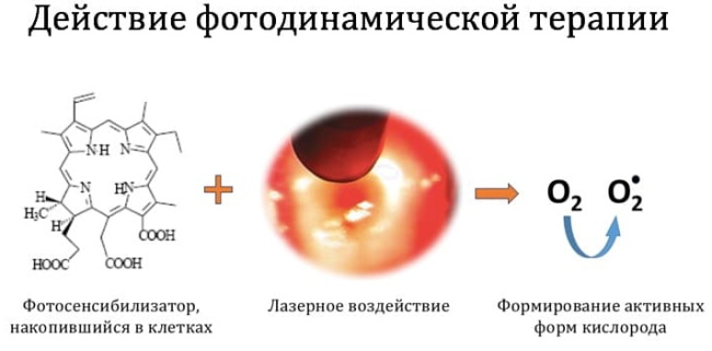 PUVA therapy (ПУВА-терапия). Что это такое от псориаза, алопеции, витилиго, расшифровка. Цена, отзывы