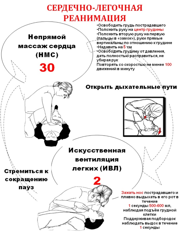 Сердечно-легочная реанимация. Что это такое, показания, алгоритм проведения, клинические рекомендации