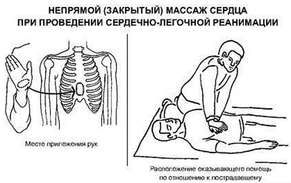 Сердечно-легочная реанимация. Что это такое, показания, алгоритм проведения, клинические рекомендации