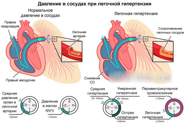 Синдромы при бронхиальной астме: ведущие основные, клинические у детей. Список