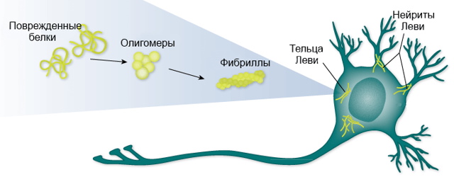 Слабоумие у взрослых. Диагноз, симптомы, признаки, лечение