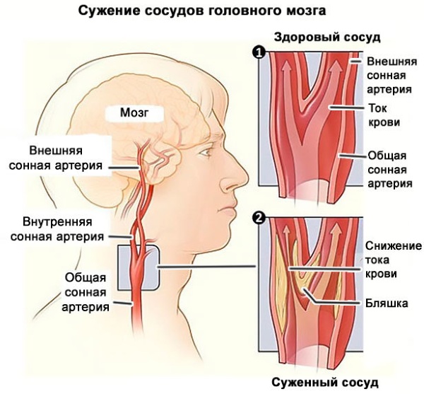 Спазм сосудов головы. Симптомы и лечение, причины