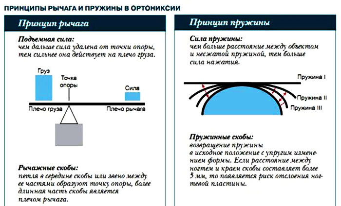 Титановая нить для ногтей вросших. Установка, сколько носить, цена