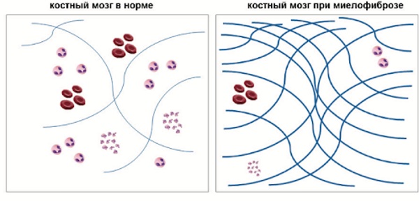 Тромбоцитопения. Причины возникновения у взрослых, беременных, что это такое, лечение