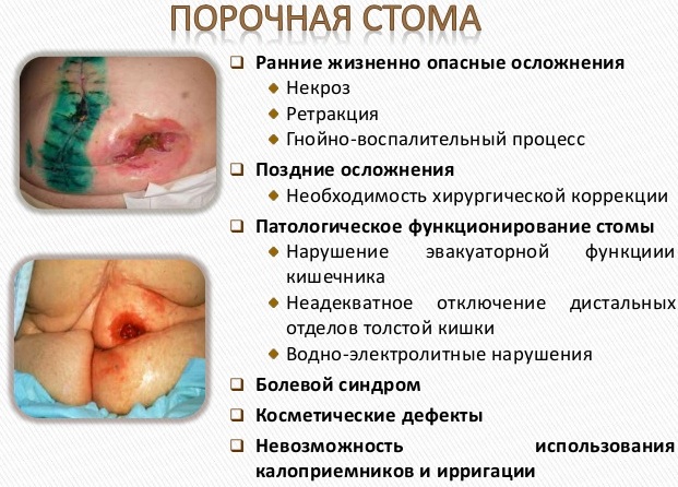 Уход за колостомой (калоприемником). Алгоритм по ГОСТу, памятка пациенту