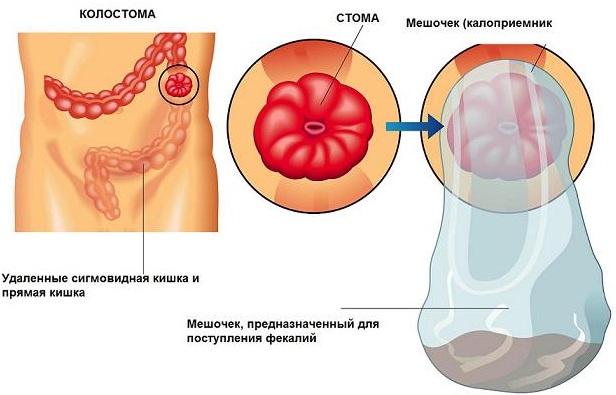 Уход за колостомой (калоприемником). Алгоритм по ГОСТу, памятка пациенту