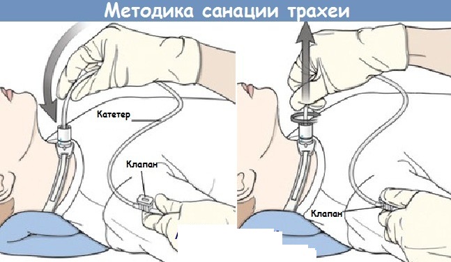 Уход за трахеостомой. Алгоритм выполнения у детей, техника, методика