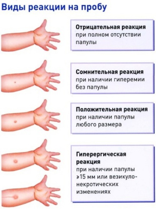 Вираж туберкулиновой пробы у детей. Что это такое, диагноз Манту, учет у фтизиатра, рекомендации