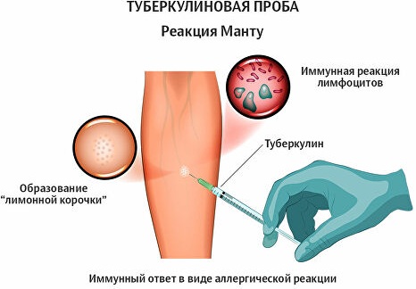 Вираж туберкулиновой пробы у детей. Что это такое, диагноз Манту, учет у фтизиатра, рекомендации