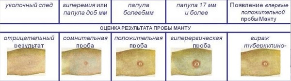 Вираж туберкулиновой пробы у детей. Что это такое, диагноз Манту, учет у фтизиатра, рекомендации