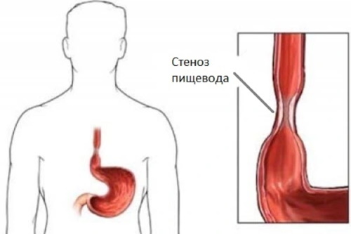 Абдоминальные боли в животе от лекарств. Что это такое, что делать