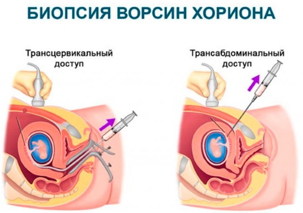 Биопсия. Что это за анализ простаты, хориона, шейки матки, эндометрия. Чем отличается от гистологии