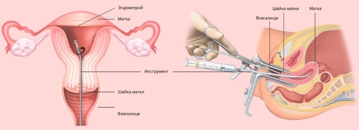 Биопсия. Что это за анализ простаты, хориона, шейки матки, эндометрия. Чем отличается от гистологии