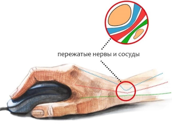 Болит кисть правой руки при сгибании, нагрузке, от мышки. Причины, лечение