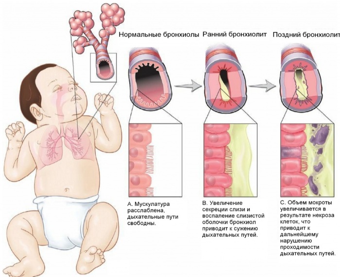 Бронхиолит. Симптомы и лечение у взрослых, что это, клинические рекомендации