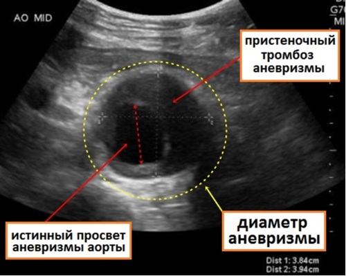 Брюшная аорта. Где расположена, размеры, норма по УЗИ, топография, ветви