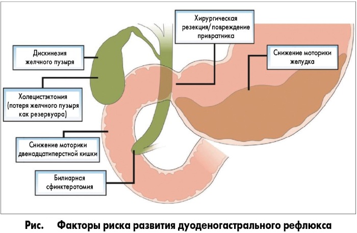 Дуоденогастральный рефлюкс (ДГР). Что это такое, причины, симптомы и лечение