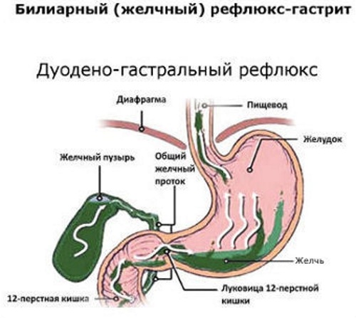 Дуоденогастральный рефлюкс (ДГР). Что это такое, причины, симптомы и лечение