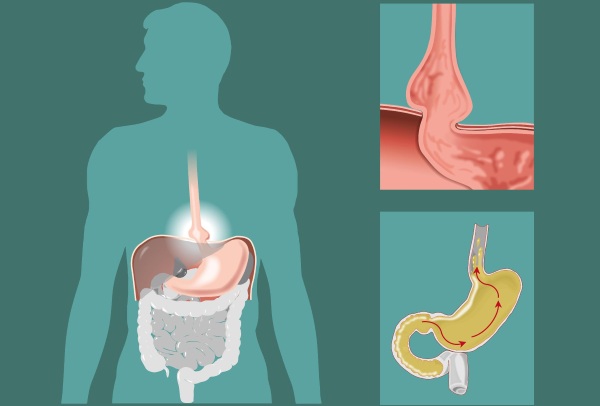 Дуоденогастральный рефлюкс (ДГР). Что это такое, причины, симптомы и лечение