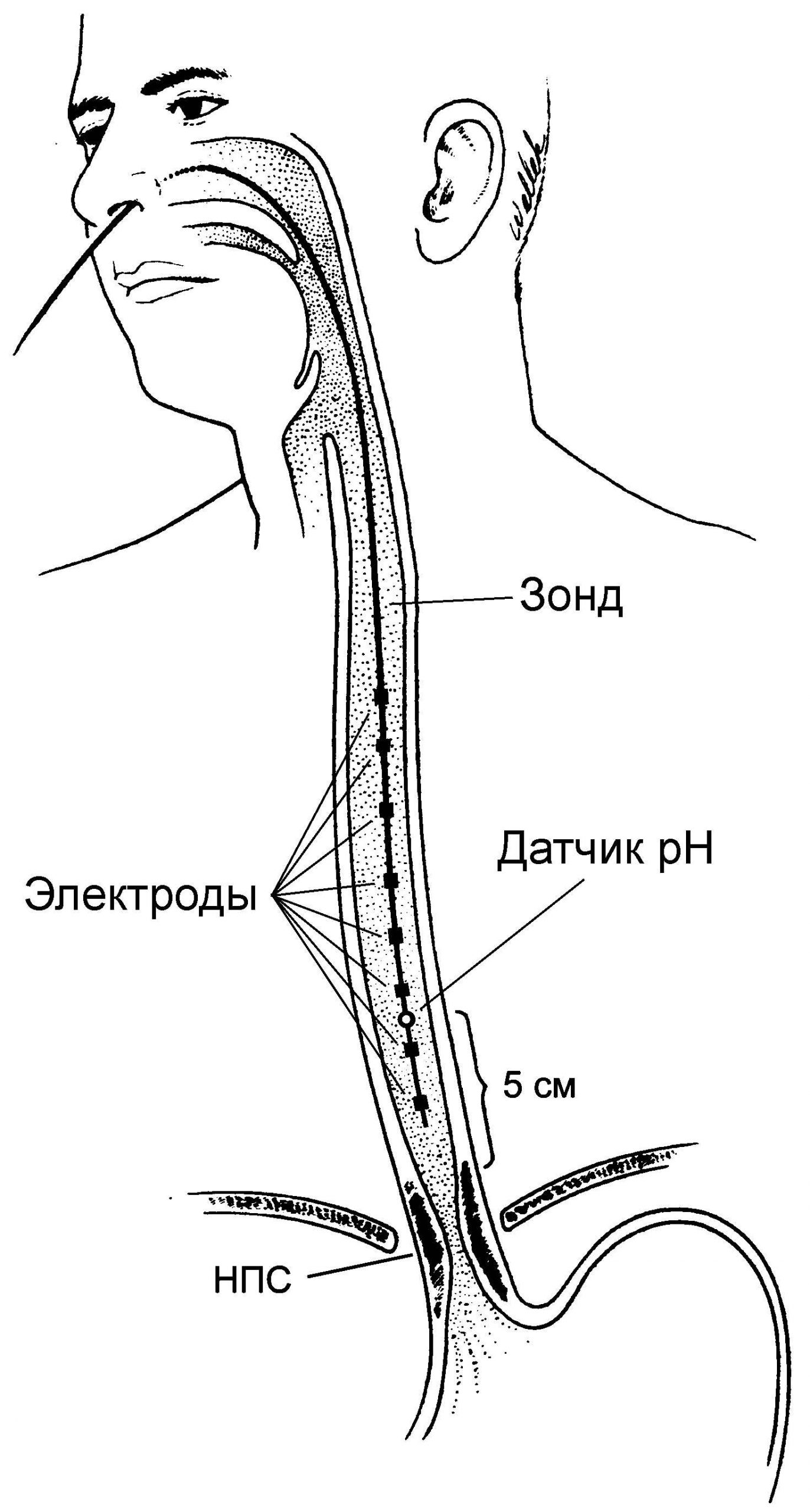 ГЭРБ (Гастроэзофагеальный рефлюкс). Симптомы и лечение, диета