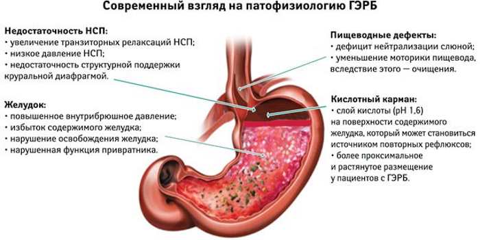 ГЭРБ (Гастроэзофагеальный рефлюкс). Симптомы и лечение, диета