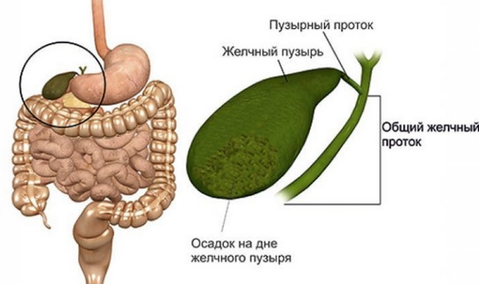 Хлопья в желчном пузыре. Лечение, что это такое у ребенка, симптомы, причины