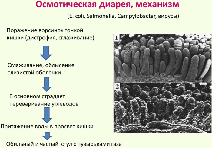 Хроническая диарея у взрослых. Причины и лечение