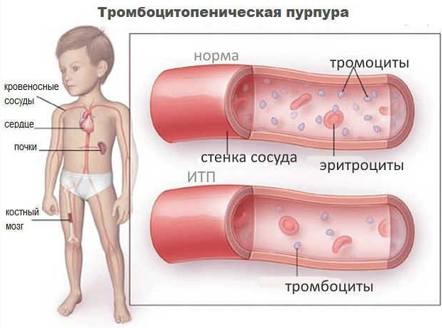 Идиопатическая тромбоцитопеническая пурпура (ИТП). Лечение, диагностика, классификация