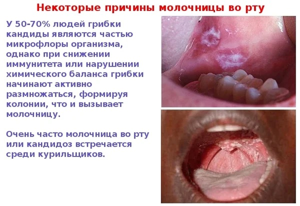 Кандидоз во рту. Фото, симптомы и лечение у взрослых, детей