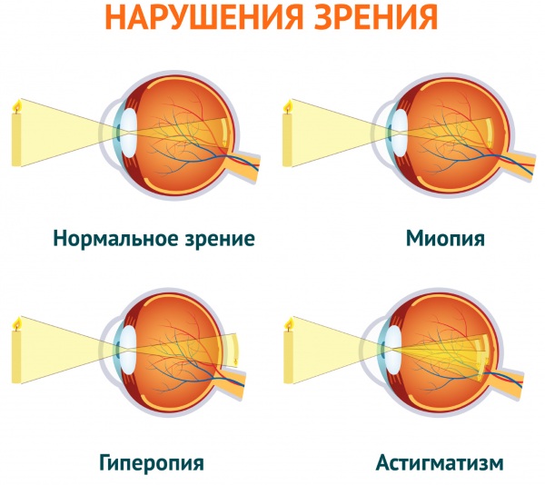 Корригирующие очки. Что это такое, где купить, как выбрать, цена