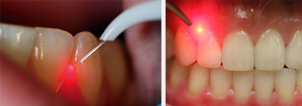 Лечение пародонтоза лазером. Отзывы, цена, противопоказания