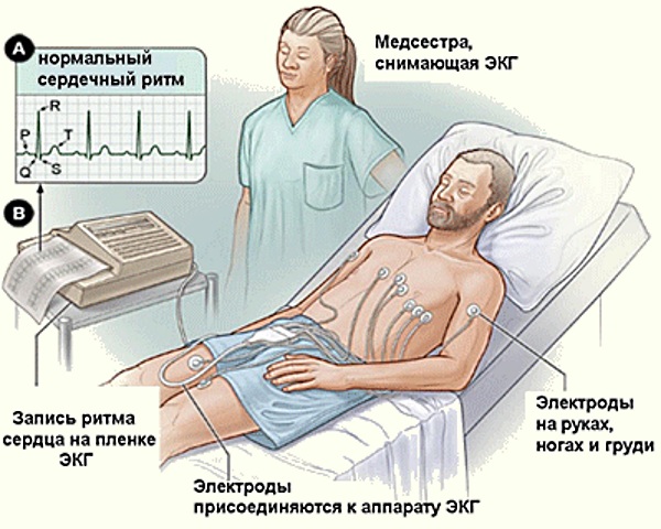 Наложение электродов при ЭКГ. Схема по цветам, алгоритм, фото