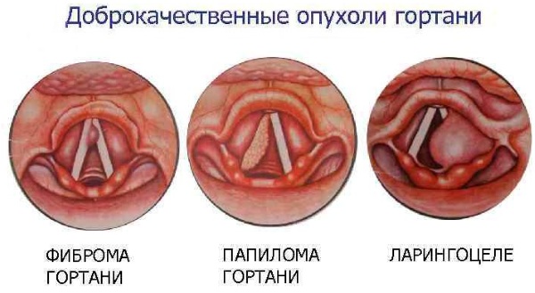 Опухоль в горле. Симптомы, психосоматика, к какому врачу обратиться, лечение