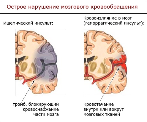 Нарушение мозгового кровообращения картинки