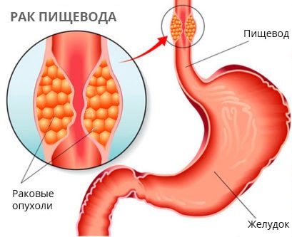 Проблемы с пищеводом. Симптомы и лечение, психосоматика