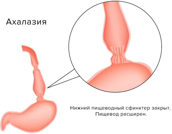 Проблемы с пищеводом. Симптомы и лечение, психосоматика