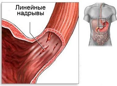 Проблемы с пищеводом. Симптомы и лечение, психосоматика