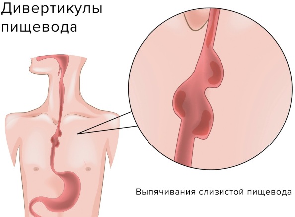 Проблемы с пищеводом. Симптомы и лечение, психосоматика