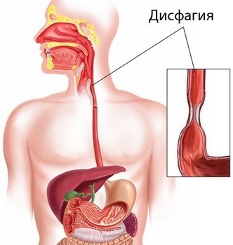 Проблемы с пищеводом. Симптомы и лечение, психосоматика