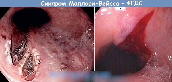 Проблемы с пищеводом. Симптомы и лечение, психосоматика