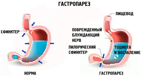 Проблемы с желудком. Симптомы, психосоматика, лечение, что можно кушать