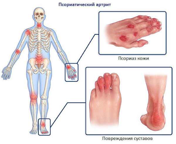 Псориатический артрит. Рентгенологические признаки, методы лечения, кто лечит, клинические рекомендации