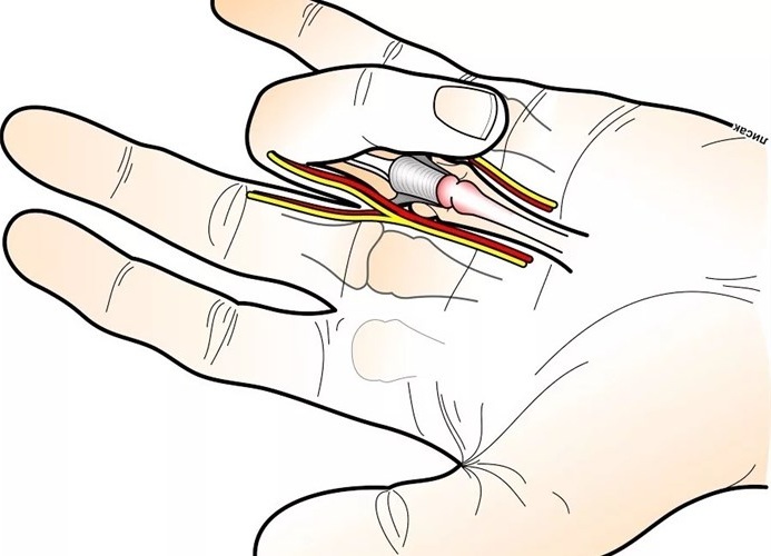 Щелкающий палец на руке. Что это такое, лечение без операции, народные средства, причины