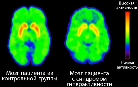 СДВГ (синдром дефицита внимания и гиперактивности) у детей. Что это такое, причины, симптомы и лечение