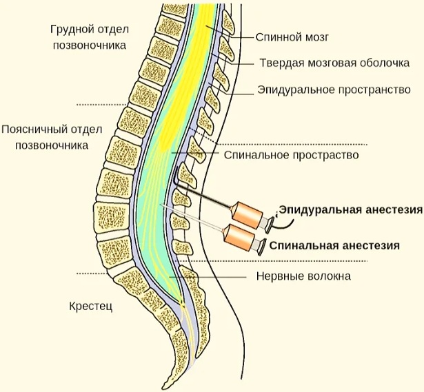 Спинальная анестезия при кесаревом сечении. Отзывы, противопоказания, последствия