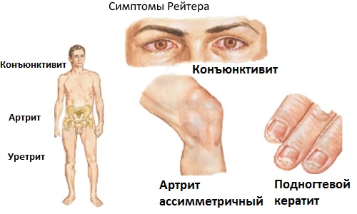 Сводит скулы и челюсть. Причины и лечение, что делать