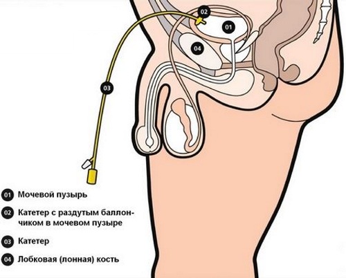 Уход за цистостомой (цистомой, эпицистостомой). Алгоритм действий, памятка, средства