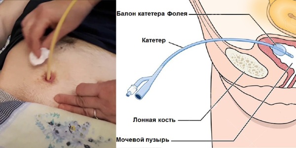 Уход за цистостомой (цистомой, эпицистостомой). Алгоритм действий, памятка, средства